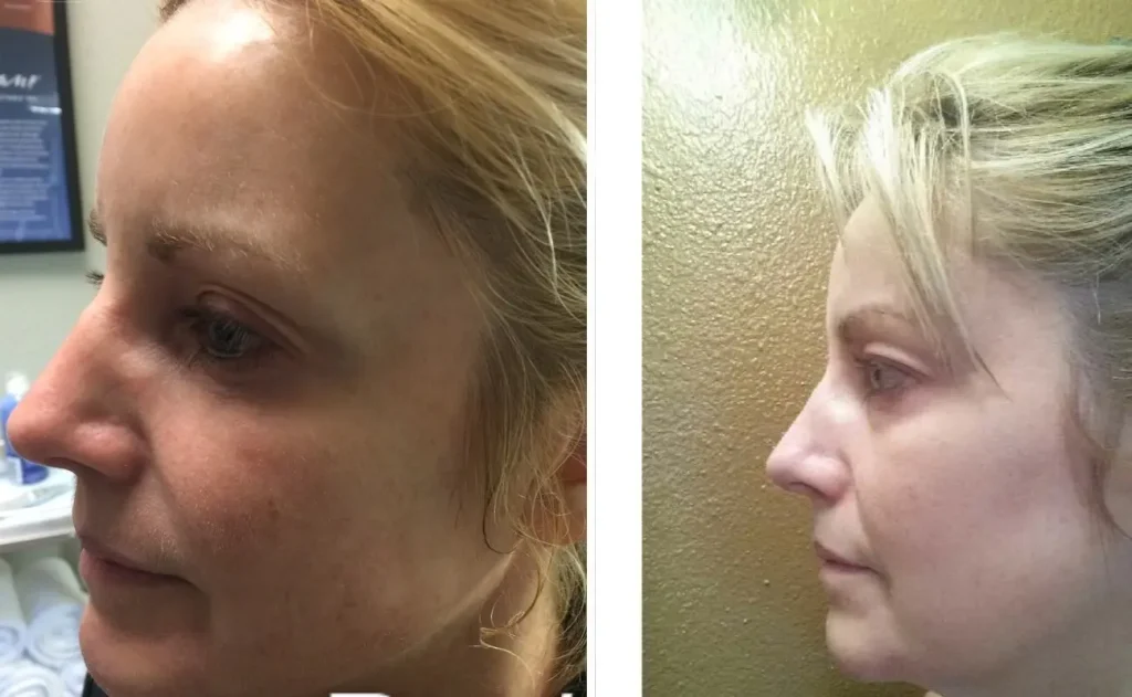 Microneedling pre-and-post, actual patient